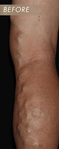 Varicose Vein Treatment Before & After Image